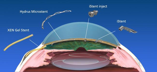 Cirurgia de Glaucoma